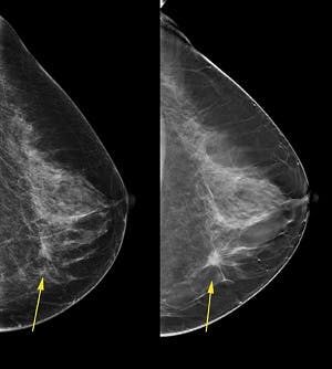 2D vs 3D Mammography