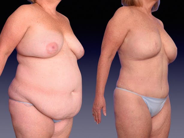 This woman had a BMI of 38.6 and had bilateral mastectomy and immediate DIEP flap reconstruction.