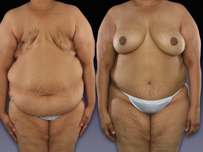 This woman had a BMI of 37.4 and had bilateral delayed DIEP flap reconstruction.