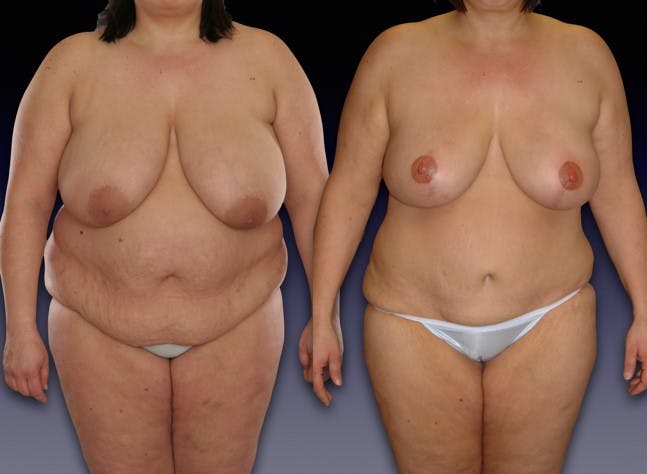 This woman had a BMI of 33 and had bilateral mastectomy with immediate DIEP flap reconstruction.
