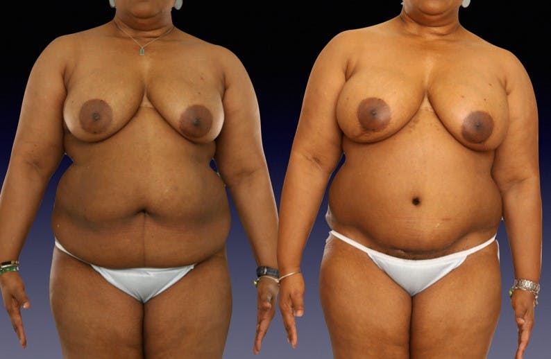 This woman had a BMI of 34.5 and had nipple-sparing bilateral mastectomy with immediate DIEP flap reconstruction.