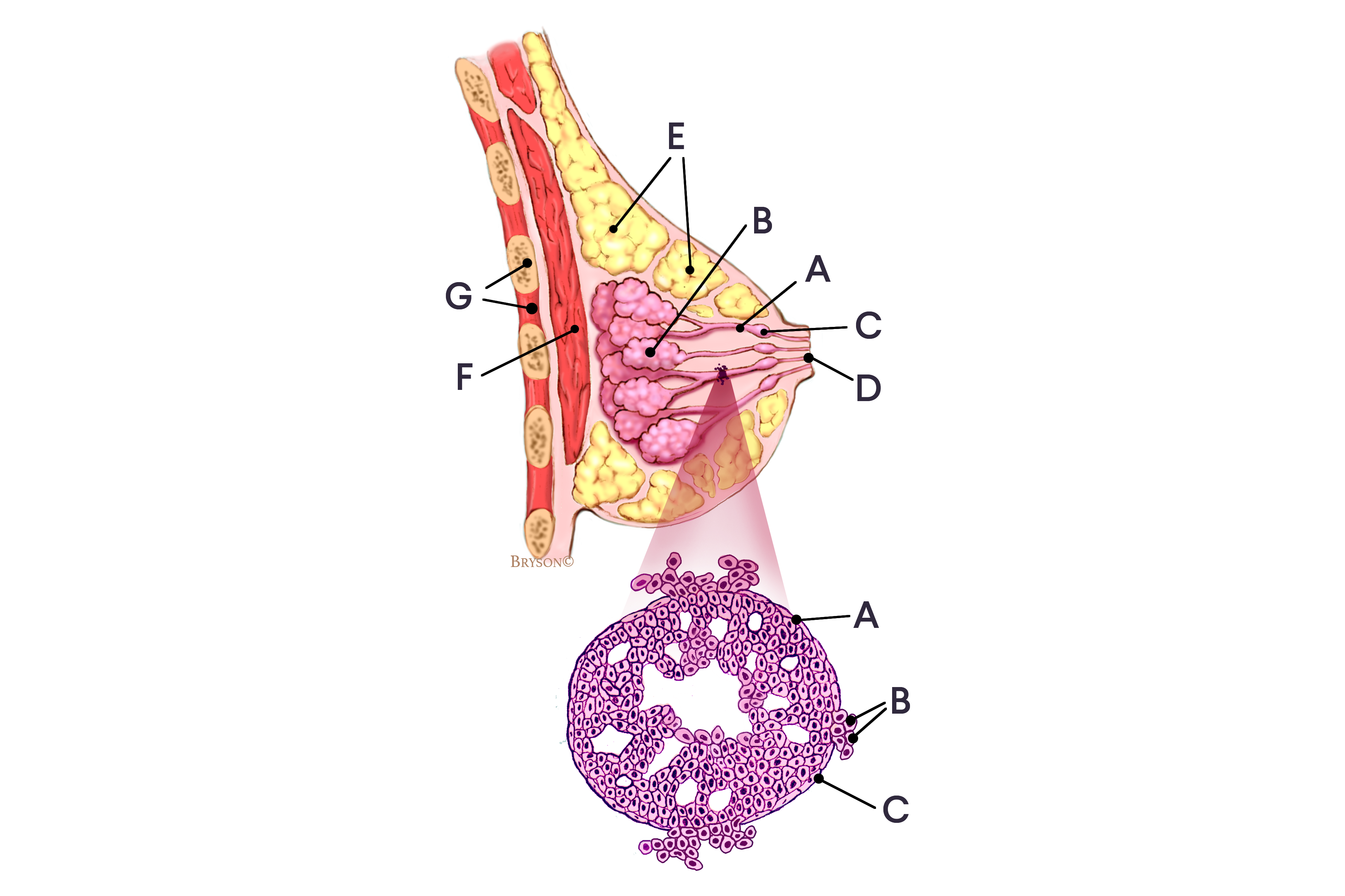 Invasive ductal carcinoma diagram