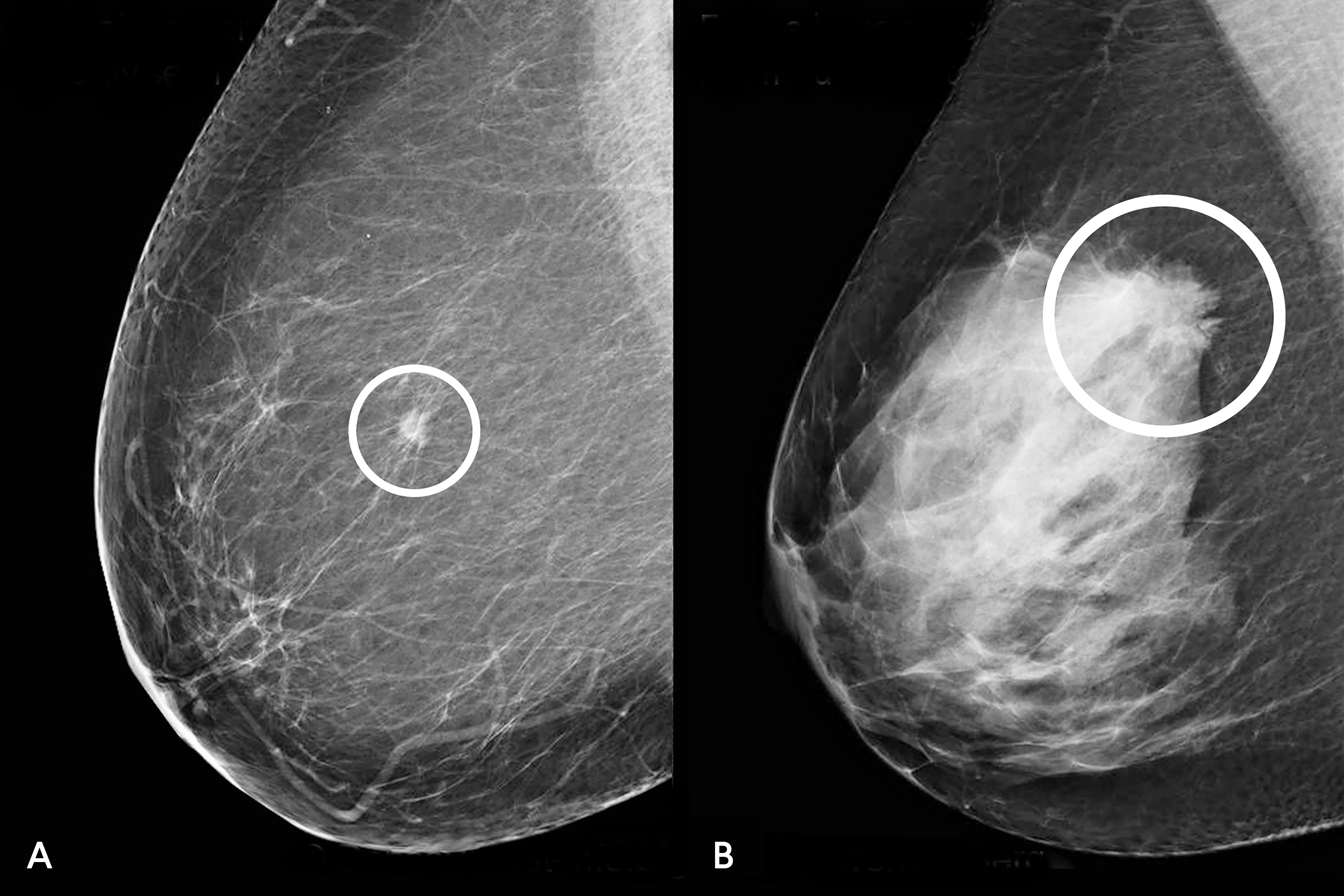 A tumor in a fatty breast vs. a dense breast